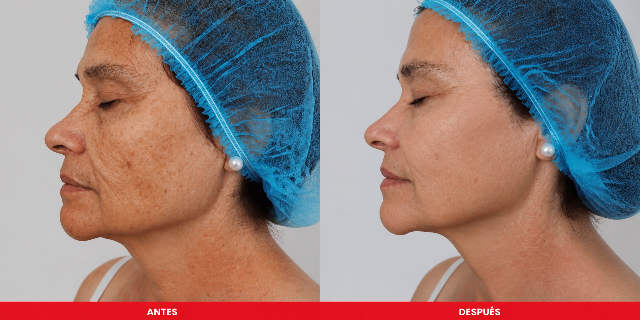 Antes y después HIFU 25D rostro completo