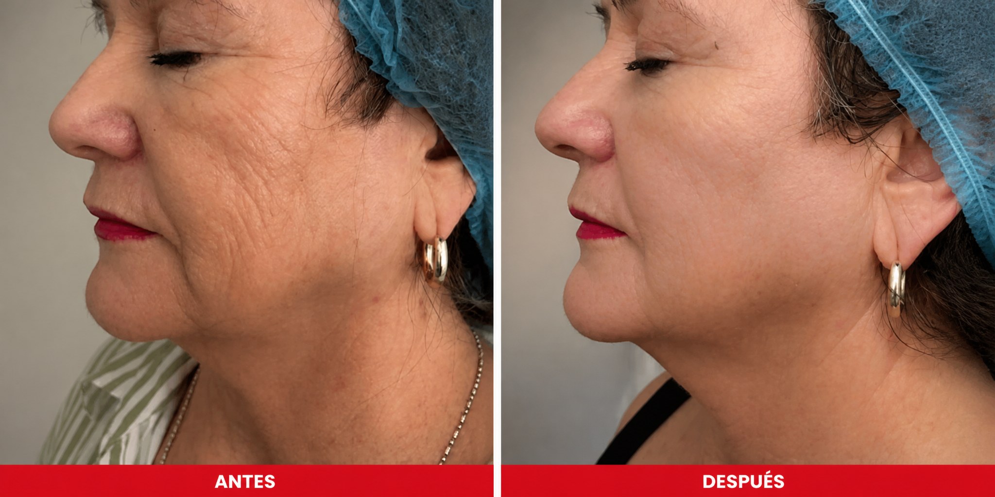 Antes y después HIFU 25D mandíbula y cuello